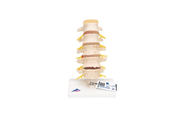 model etapów wypadnięcia dysku i zwyrodnienia kręgów - 3b smart anatomy - 1000158 [a795] 3b scientific modele anatomiczne 2